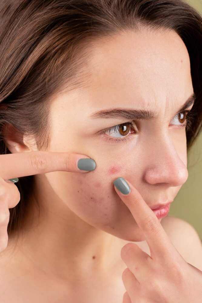 Powerful Acne Treatments For All Ages